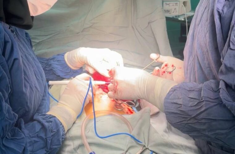 خارج کردن توموری بزرگ از شکم کودک ۱۰ ساله رشتی